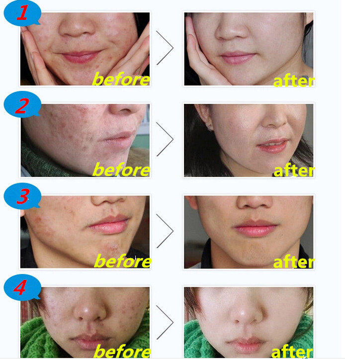 Bioaqua Krim Wajah Anti Acne Rejuvenation Cream 30g Blue Jakartanotebook Com